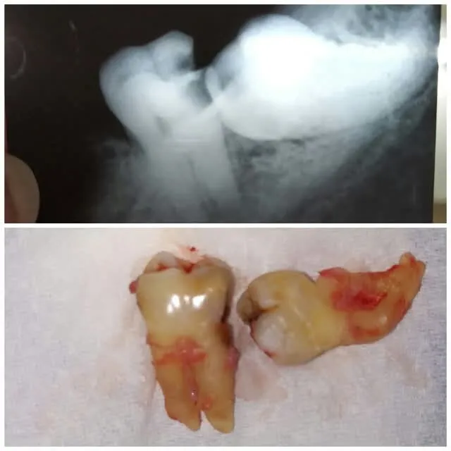 Surgical Extraction of Molar Roots - Before & After Dental Treatment