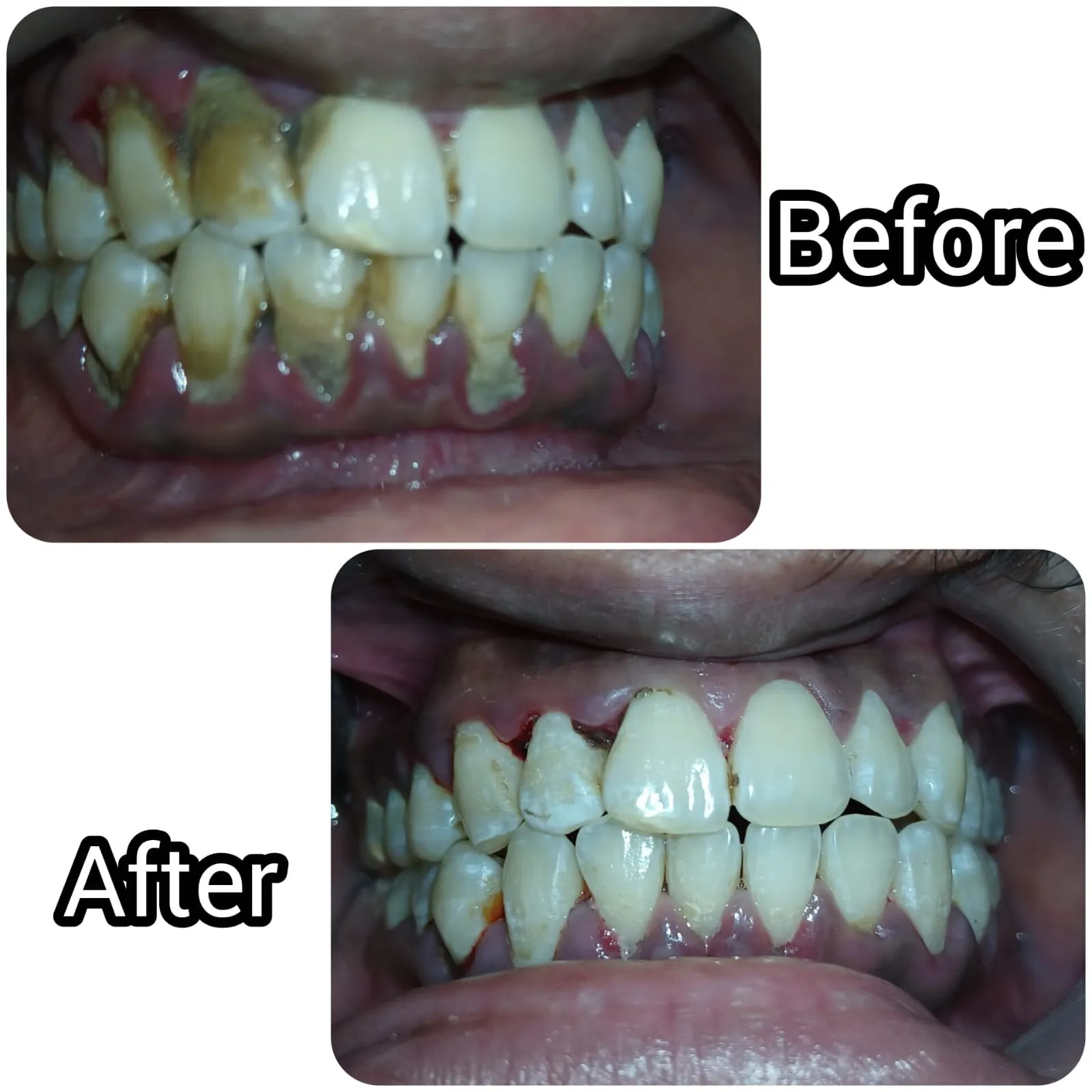 Periodontal Scaling & Tartar Removal - Before & After Dental Treatment