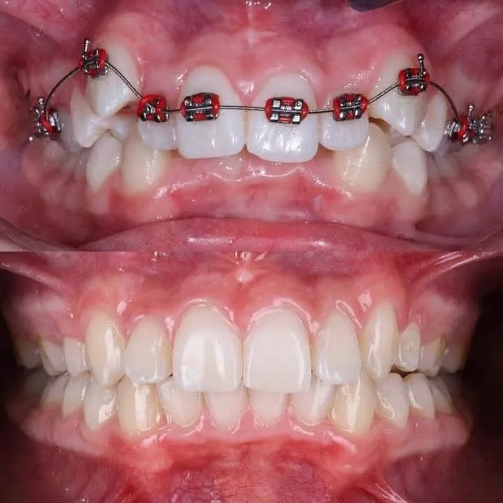 Orthodontic Braces Therapy - Before & After Dental Treatment