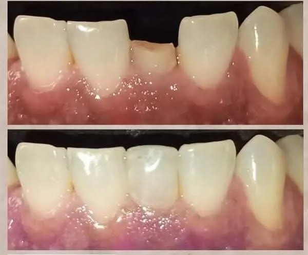 Aesthetic Lateral Restoration - Before & After Dental Treatment