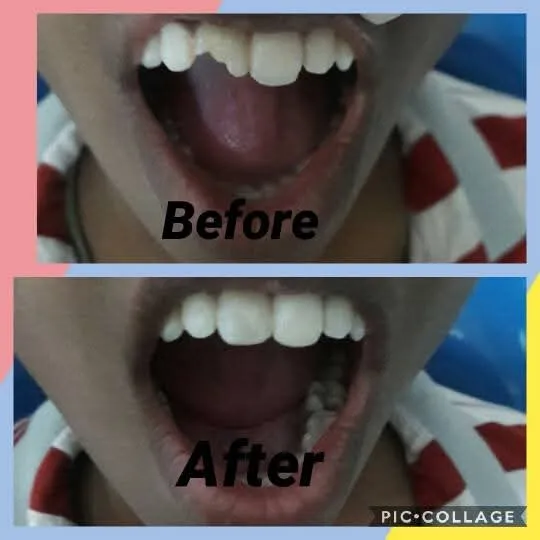 Incisor De-rotation Bonding - Before & After Dental Treatment